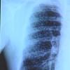 Pulmones afectados por silicosis